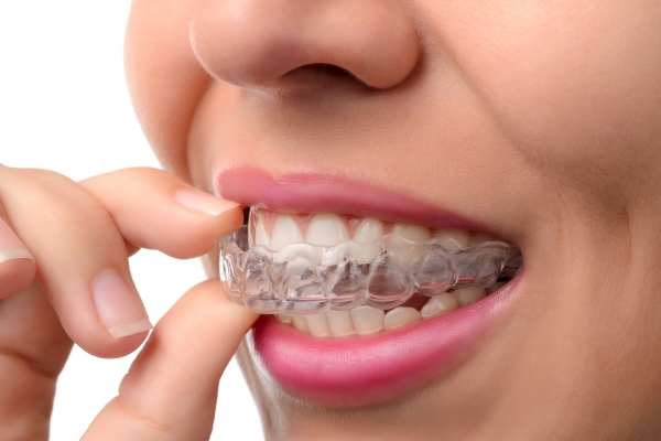Woman putting in her aligners